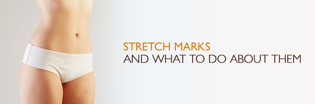 Stretch Mark