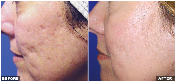 Laser wrinkle treatment