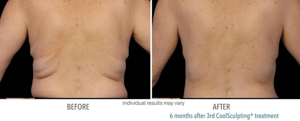 coolsculpting bra fat