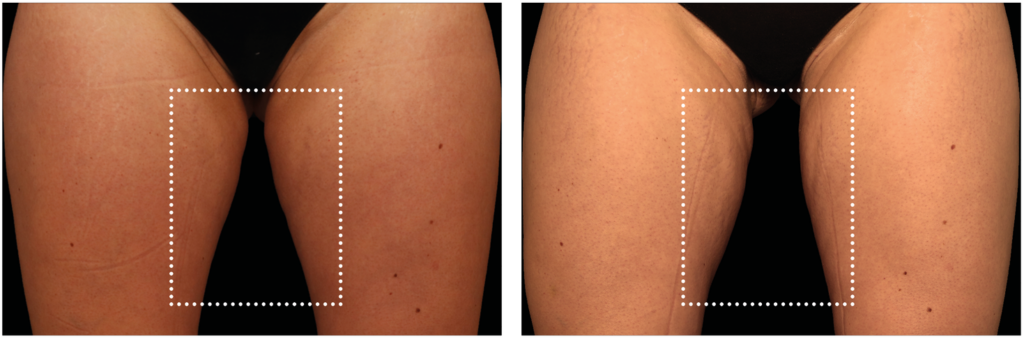 Emsculpt neo_inner thighs