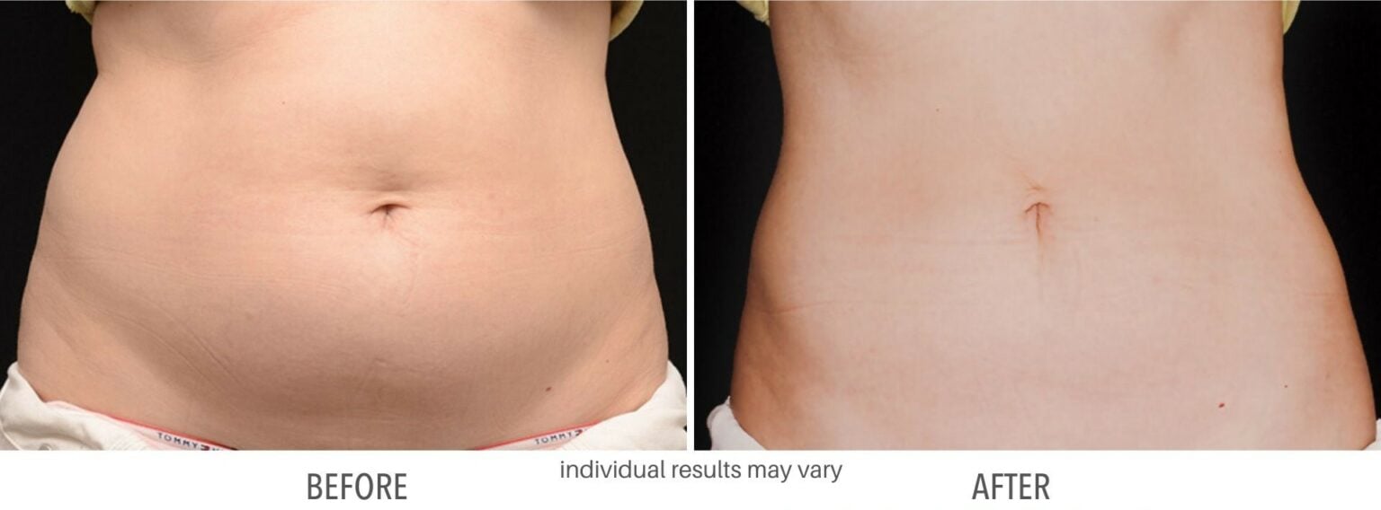 coolsculpting abdomen