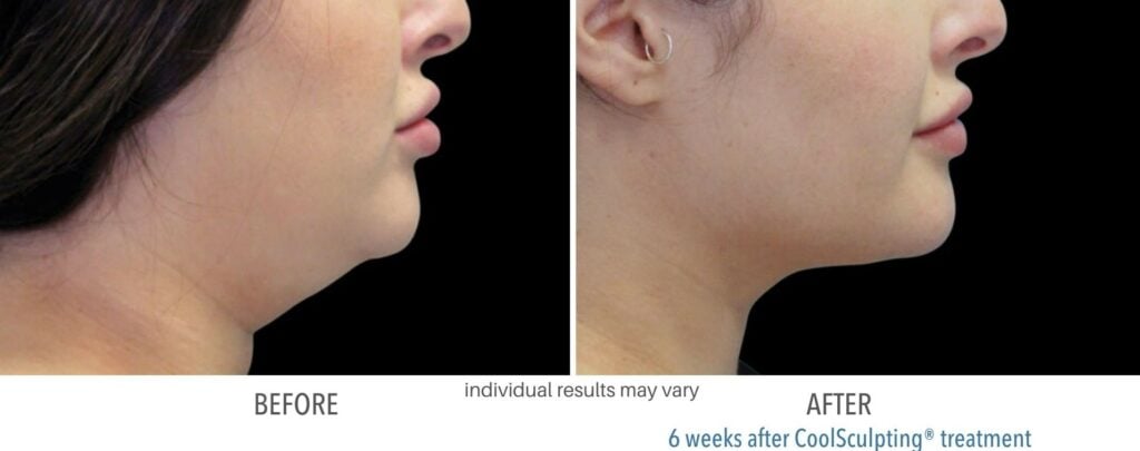 coolsculpting neck