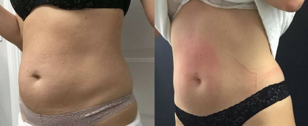 emsculpt neop abdomen