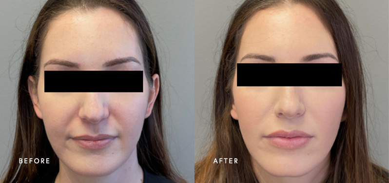 Before and after: cheeks treated with dermal filler