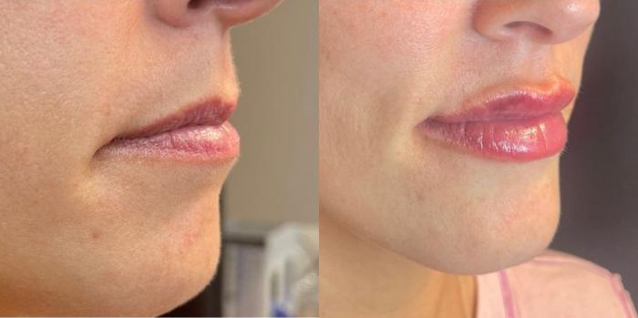 Before and after: lips treated with dermal filler