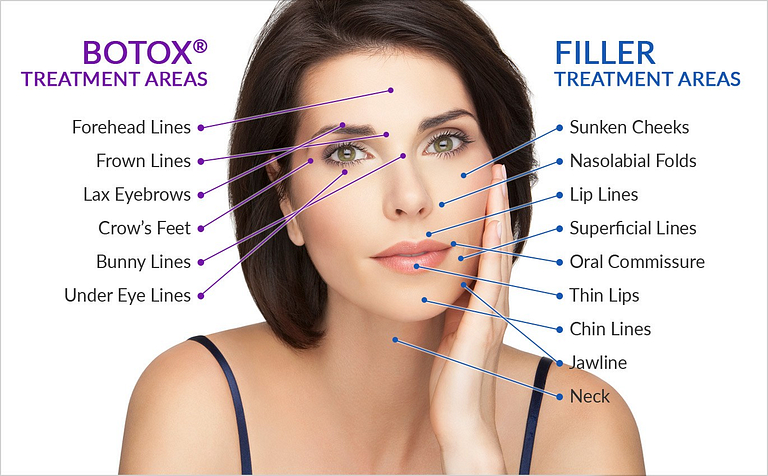 Diagram of common Botox treatment areas, such as forehead, frown and crow's-feet lines, and filler treatment areas, such as cheeks, lips, folds, chin and jawline