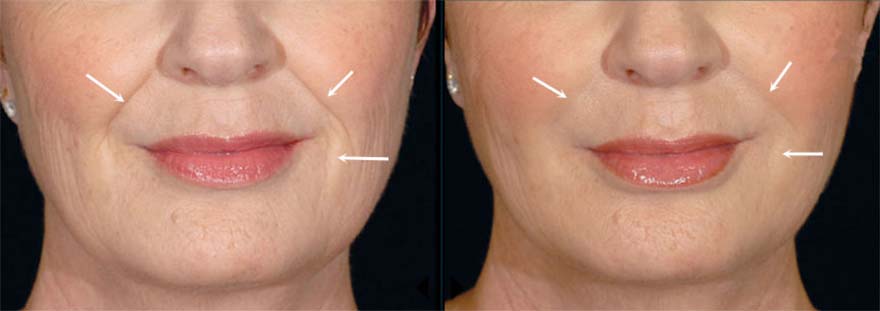 Before and after: smile lines treated with dermal filler